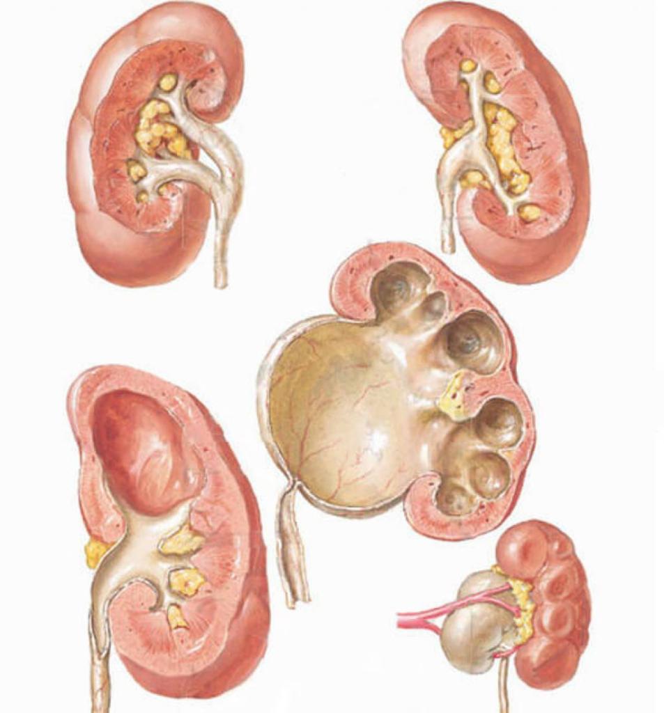 Расширенные почки. Расширение лоханки гидронефроз. Гидрокаликоз почек. Расширение лоханки почки пиелоэктазия.