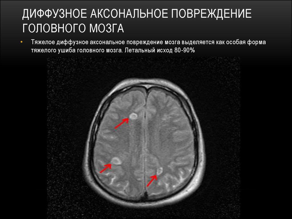 Диффузная травма мозга