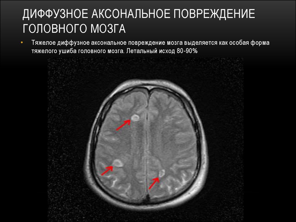 Диффузная дезорганизация головного мозга