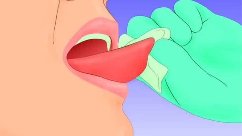 Остановка кровотечения из языка