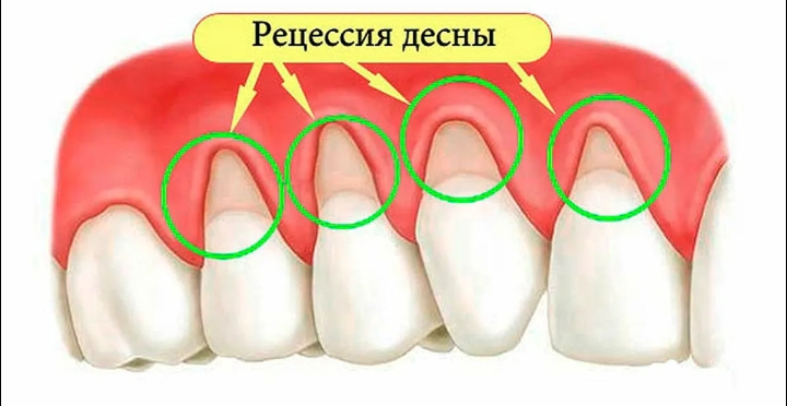 Оголились корни зубов