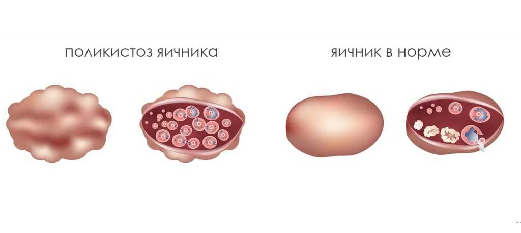 Поликистоз яичника