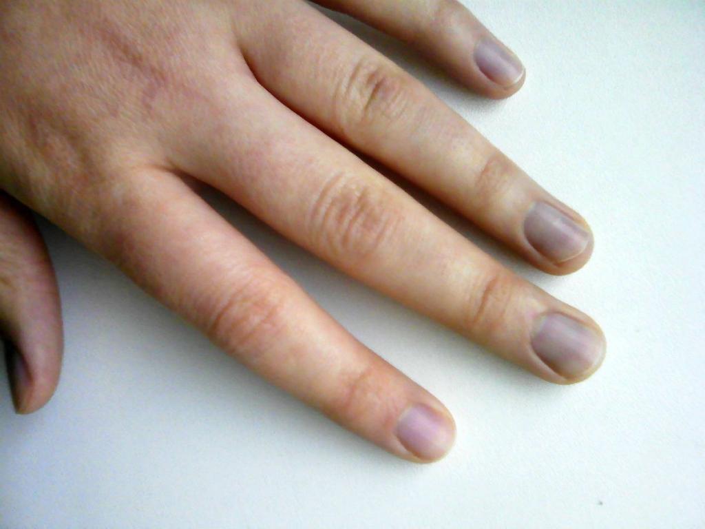 Синяки под ногтями: чем опасна гематома и как ее лечить - 17 октября, Статьи «Кубань 24»