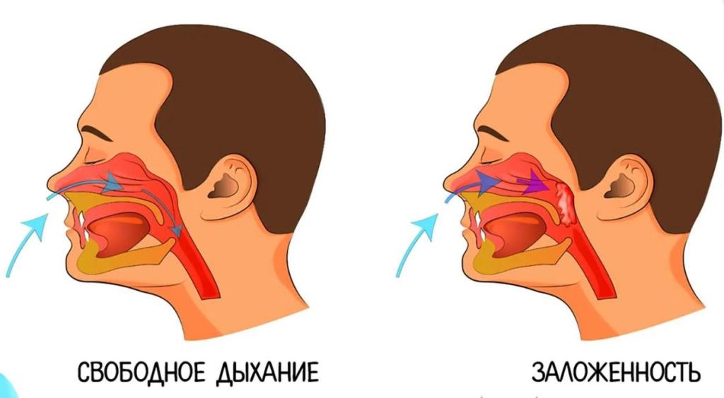 Хроническая заложенность носа