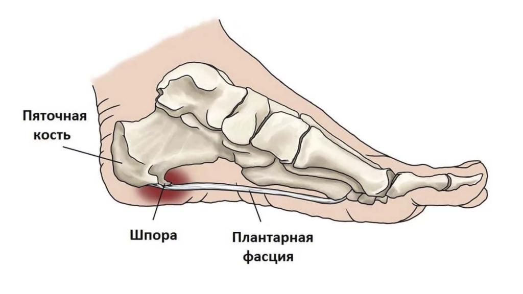 Пяточная шпора