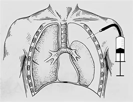 Методы дренирования плевральной полости