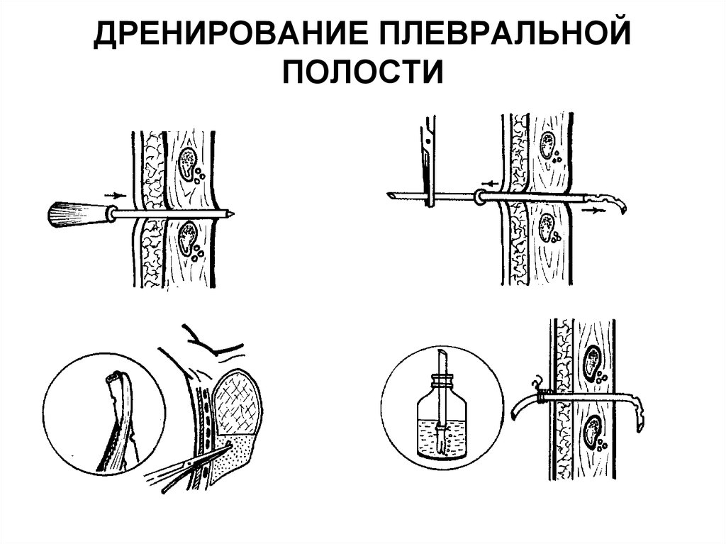 Методы дренирования плевральной полости