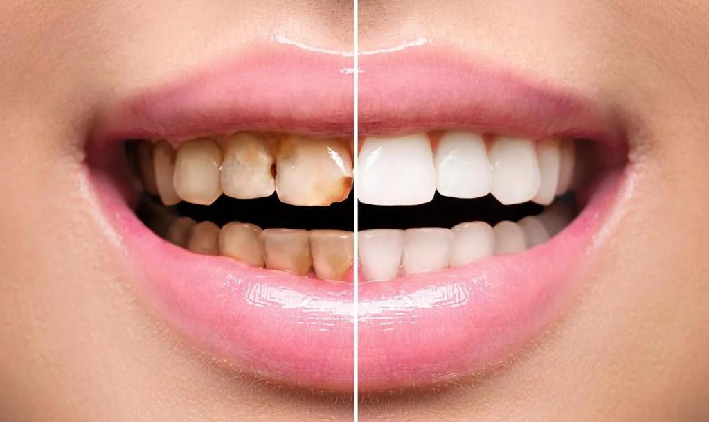 Зубы до и после реставрации