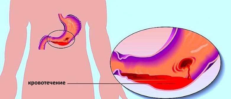 Желудочное кровотечение