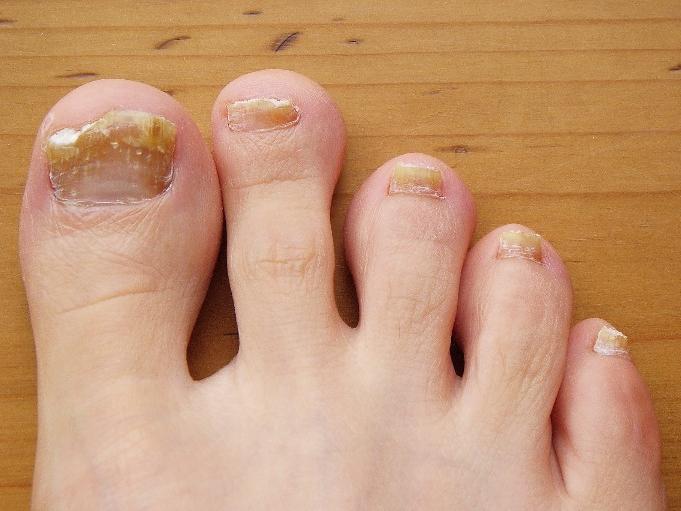 Effective treatment of nail fungus