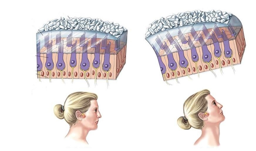 Отолиты в вестибулярном аппарате фото