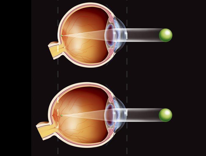 витаминные капли для глаз какие лучше при глаукоме
