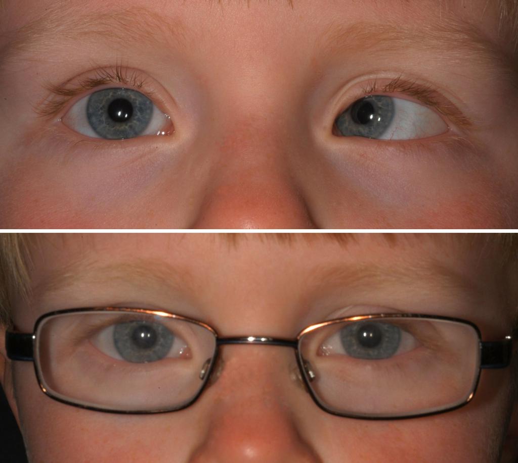 Астигматизм фото глаз и сравнение со здоровым
