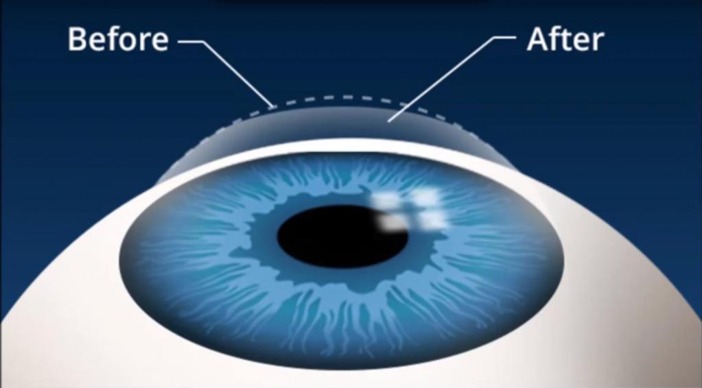 Сколько стоит операция, корректирующая зрение?