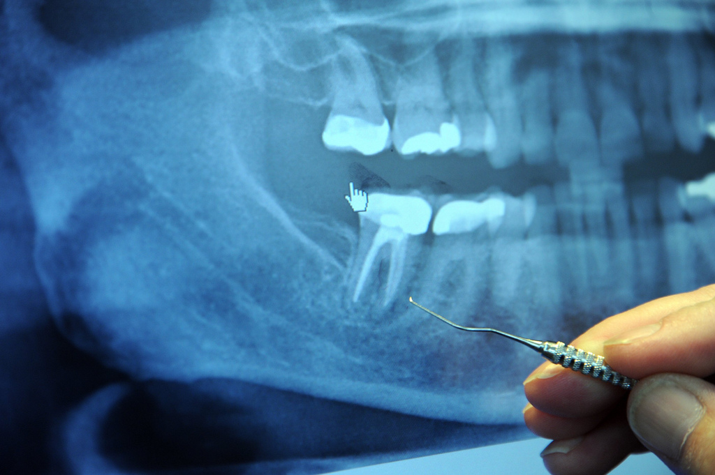 Сколько живет мертвый зуб без нерва?