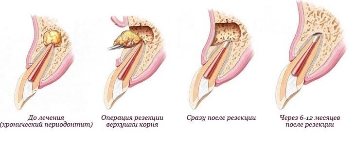 Резекция верхушки корня зуба.