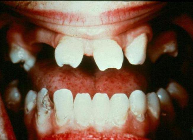 Зубы гетчинсона фурнье 19