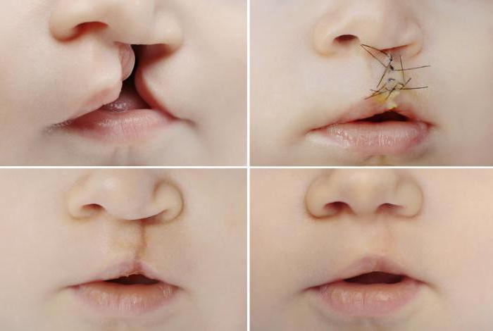 причины рождения детей с заячьей губой
