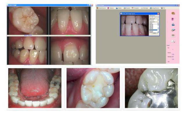 Интраоральные камеры стоматологические