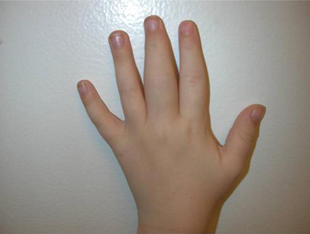 Arthritis of the fingers