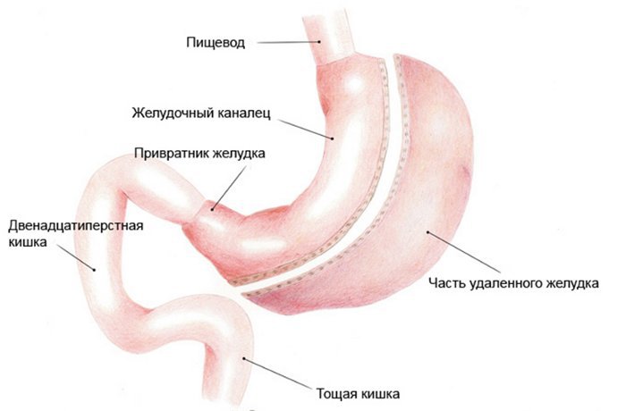 Удален желудок. Гастропластика желудка. Операция по удалению части желудка.