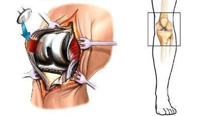 Протезирование коленного сустава