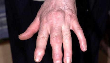 Опух средний палец на руке