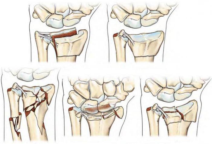 Описание перелома лучевой кости в типичном месте thumbnail
