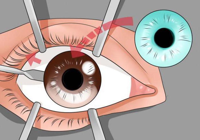 операция по смене цвета глаз отзывы