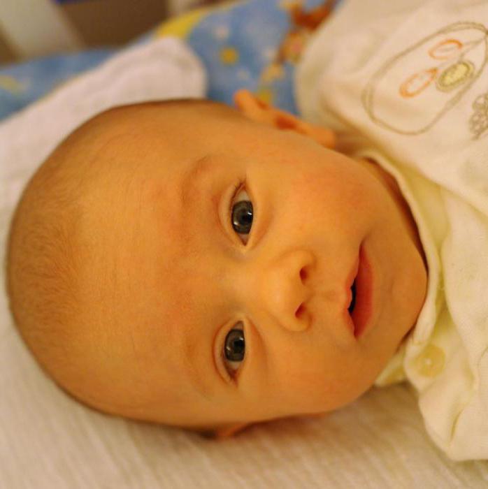 неонатальная желтуха новорожденного