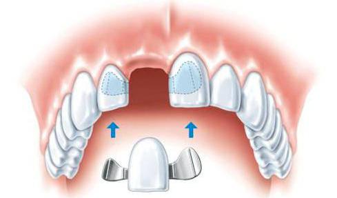замена зуба цена