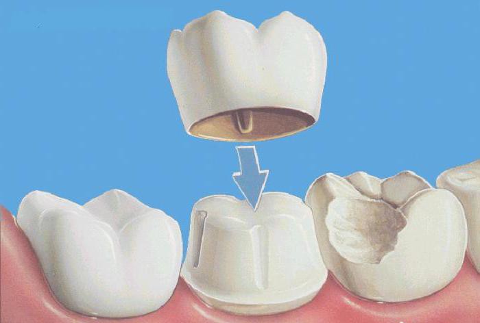 стоматологическое протезирование