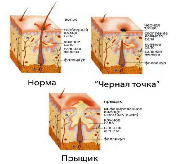 крем от прыщей чистая линия