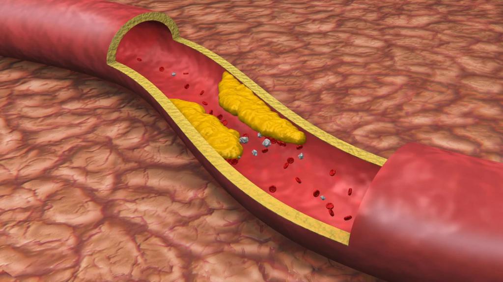 Холестериновая бляшка
