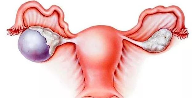 доброкачественное новообразование яичника