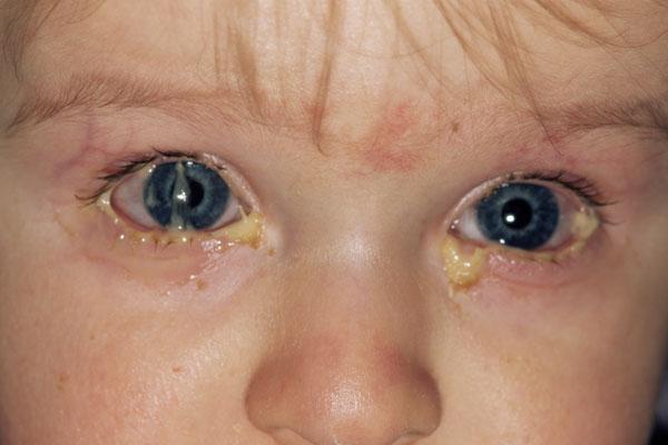 Гноятся глаза у ребенка - причины появления выделений, диагностика и средства лечения