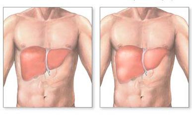 hepatomegaly diffuse liver changes