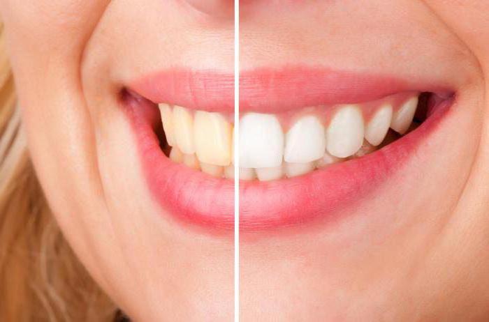Как снять чувствительность зубов после отбеливания