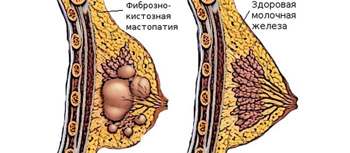 Как правильно прикладывать капустный лист при мастопатии
