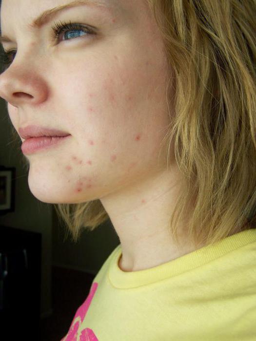 Сыпь на лице от женских заболеваний thumbnail