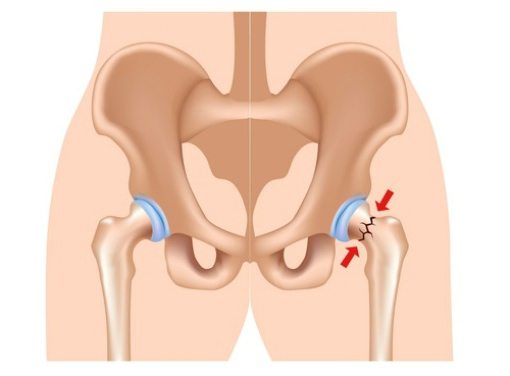 переломы шейки бедра