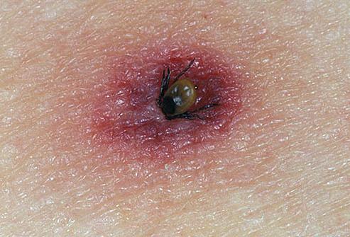 What does an encephalitis tick look like?