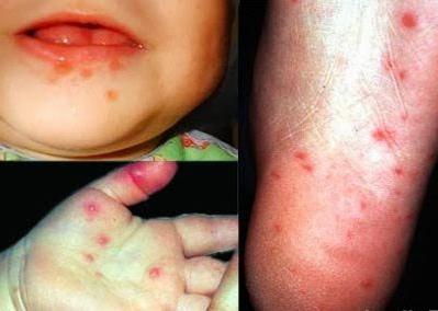 enterovirus infection in a child treatment