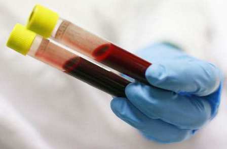 гипохромия в анализе крови общем