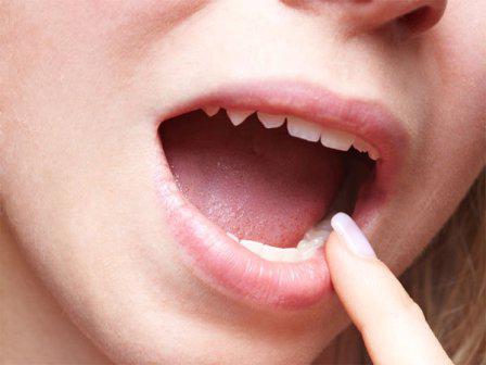 лечение заболеваний слизистой полости рта