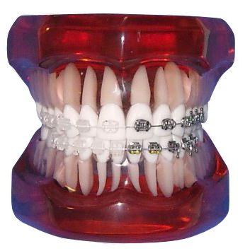 metal-ceramic crowns on teeth