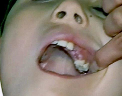 режутся коренные зубы симптомы