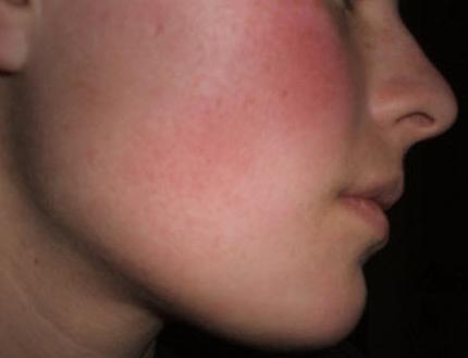 Аллергия на лице что пропить thumbnail
