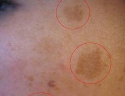 Пигментные пятна на коже: причины, симптомы, тактика лечения, риски