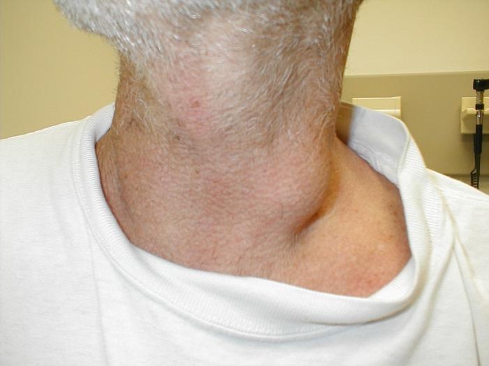 Воспаление лимфоузлов на шее у ребенка причины и лечение фото